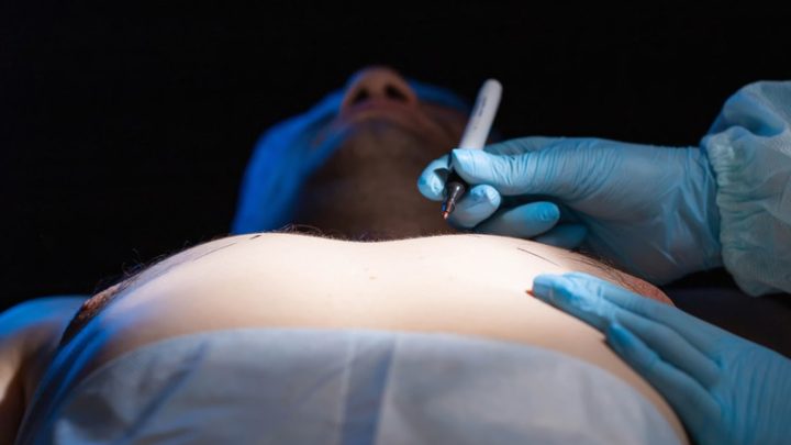 What Symptoms Should I Look for If I Think I Have Gynecomastia?